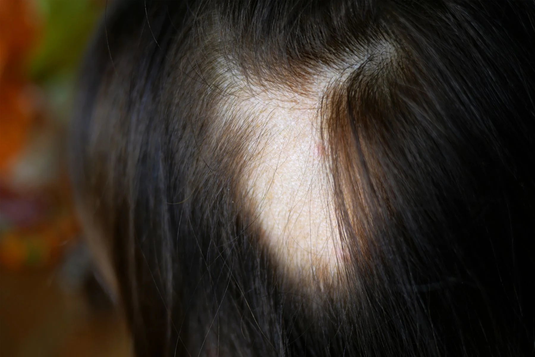 Alopecia areata: De ce apare căderea părului în arii rotunde?